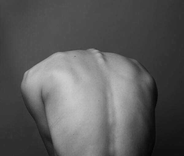 Scoliosis