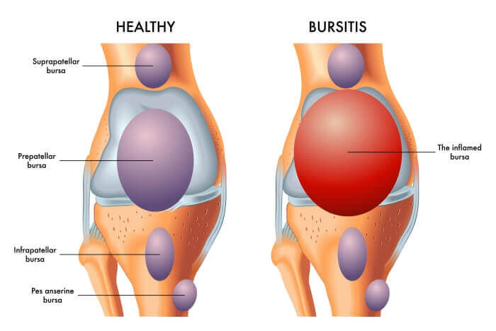 what is the difference between arthritis and bursitis