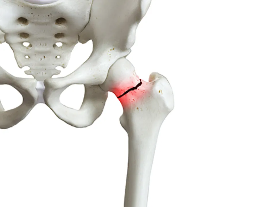 Hip Replacement After a Fracture Empower Medicare Supplements