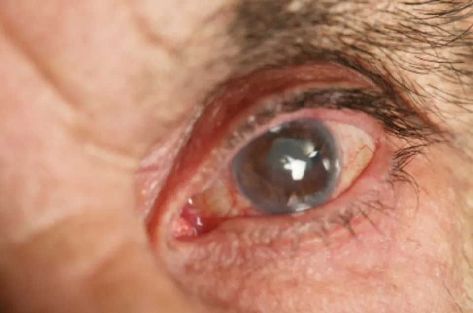 How Common Are Cataracts? The Fact!