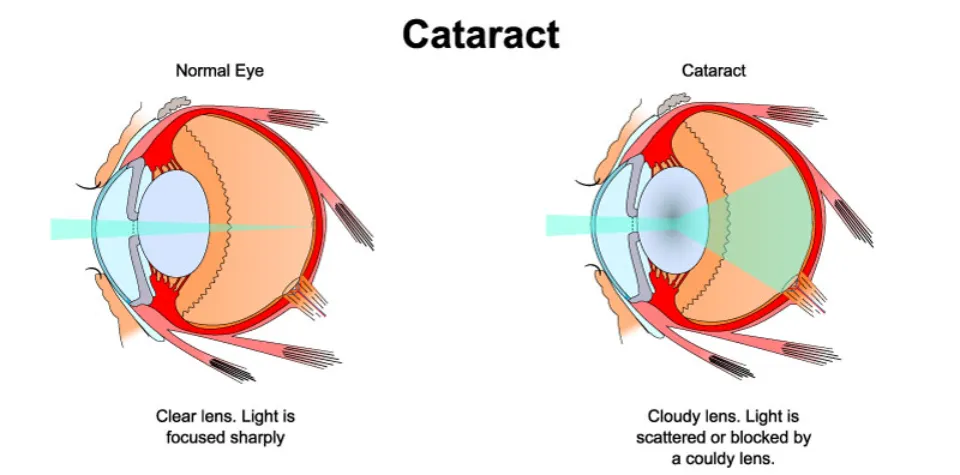 How Common Are Cataracts? The Fact!