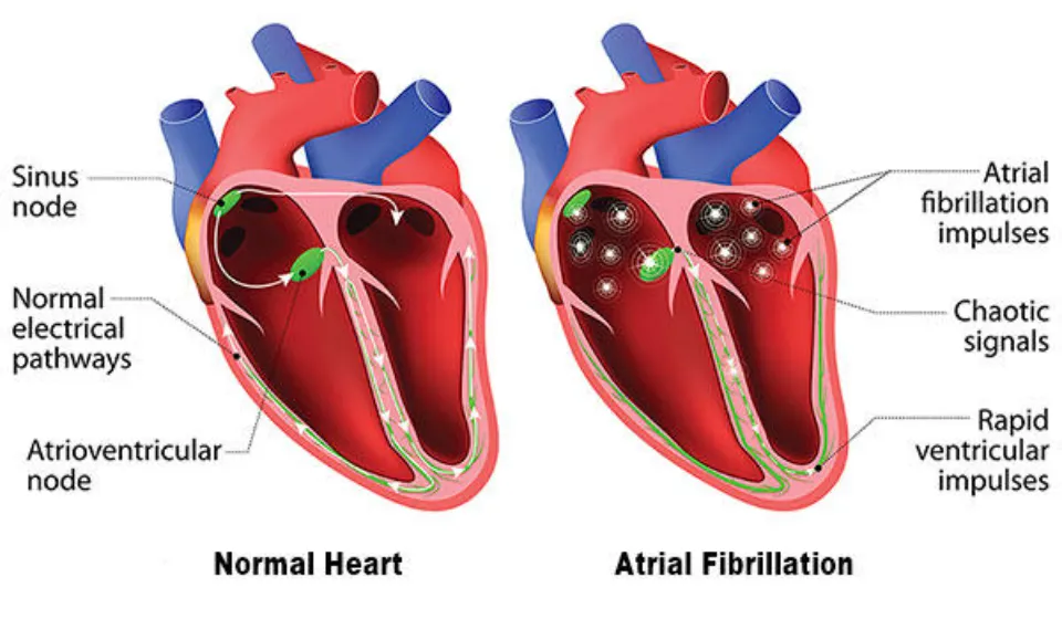 How Dangerous is Afib in Elderly: Alert!