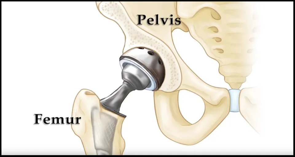 How Do You Fix a Loose Hip Replacement? (Solved)