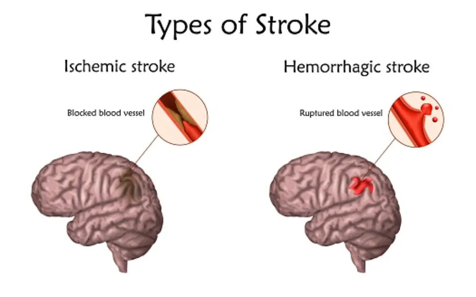 How Does AFib Cause Stroke? Definition and Treatments