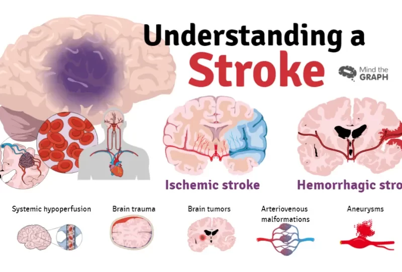 How Does AFib Cause Stroke? Definition and Treatments