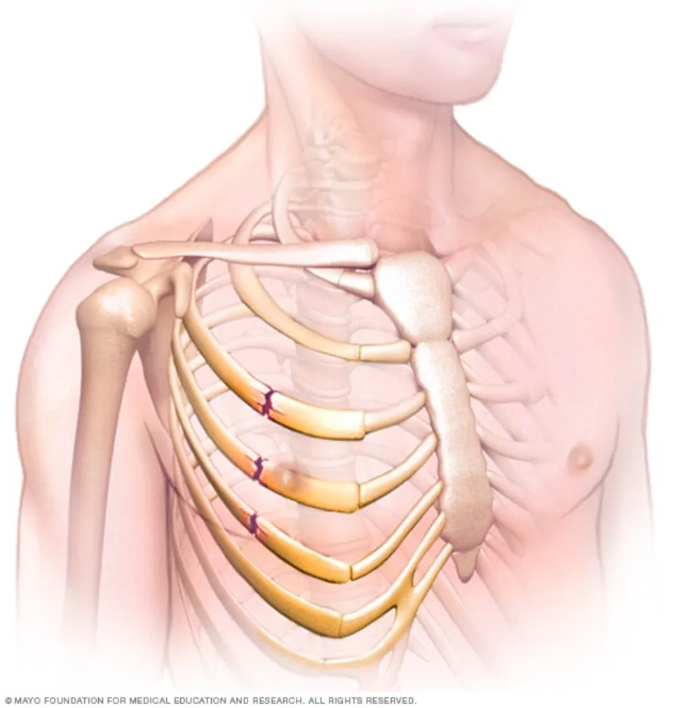 How Long Do Broken Ribs Take to Heal in Elderly: Longer