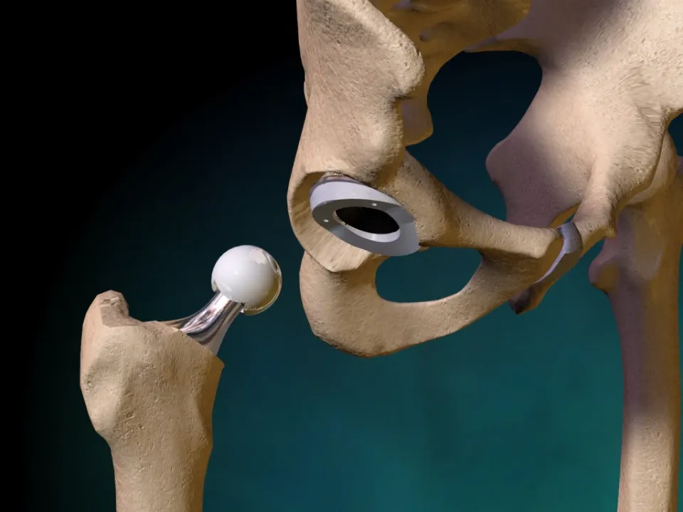 How Much Does a Titanium Hip Replacement Weigh?