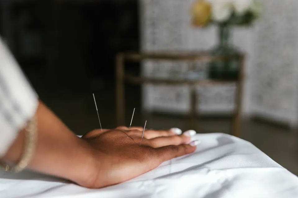 How Often Should You Get Acupuncture: Follow These Things