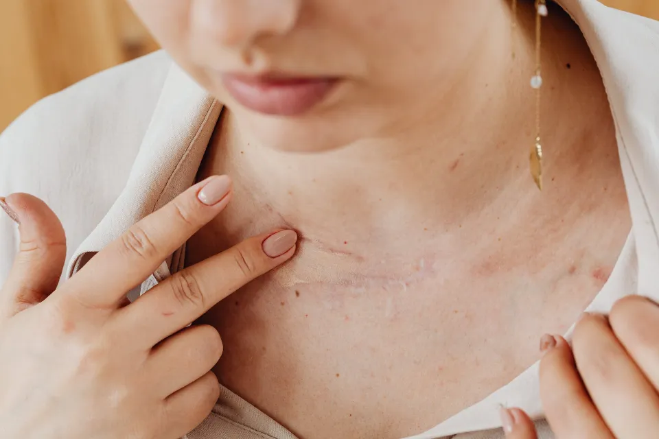 How To Prevent Scarring From Stitches: Things You Can Or Cannot Do￼