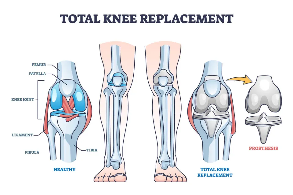 Knee Replacement Market 2023 Forecast to 2030 Market Segmentation