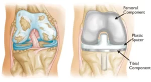 A Complete Guidance of Knee & Hip & Shoulder Replacement (2023)