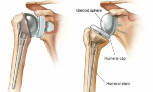 A Complete Guidance of Knee & Hip & Shoulder Replacement (2023)