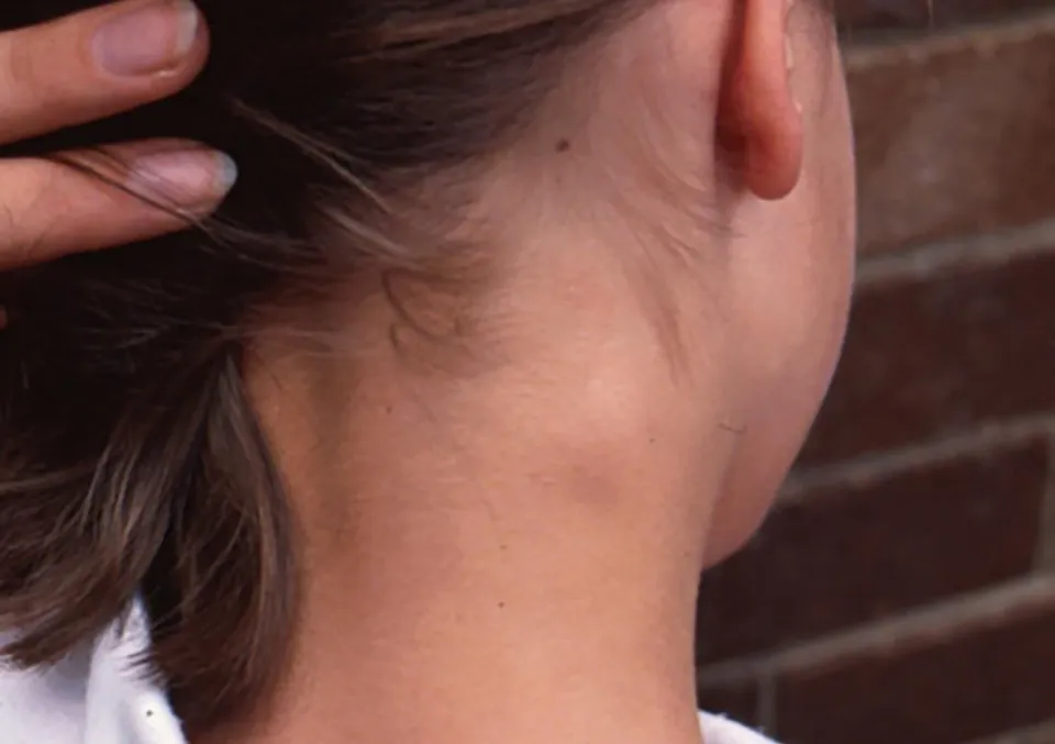 A Knot in Your Neck: Causes & How to Get Rid Of?