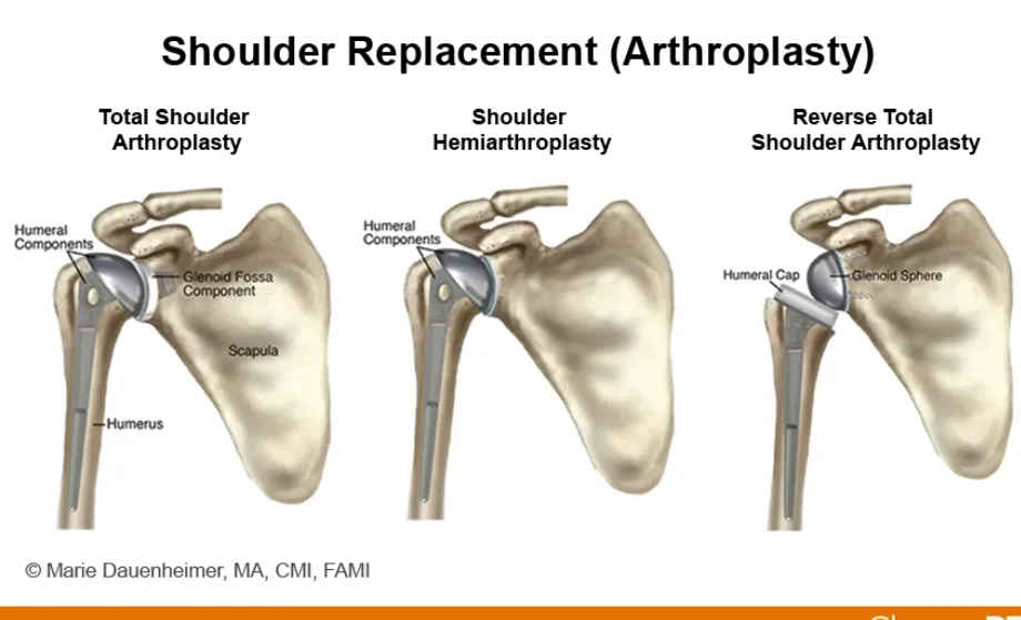 After Shoulder Replacement: How Long to Therapy?