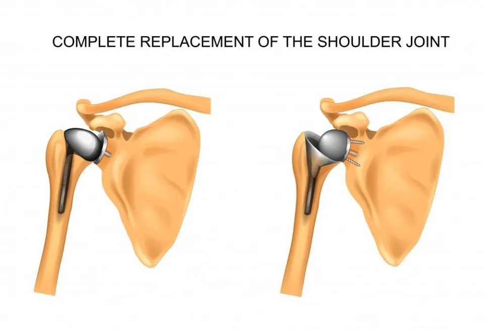 After Shoulder Replacement: How Long to Therapy?