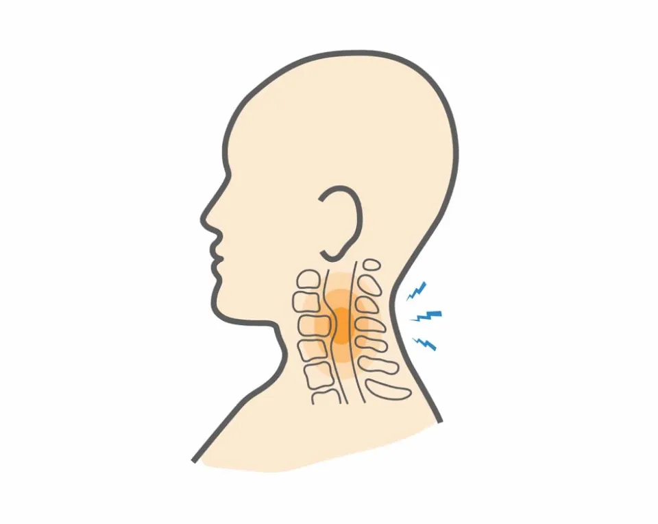 Cervical Myelopathy: Causes, Symptoms, Treatments