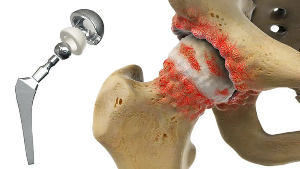 Hip Replacement Preparation: Tests Are Done before Surgery