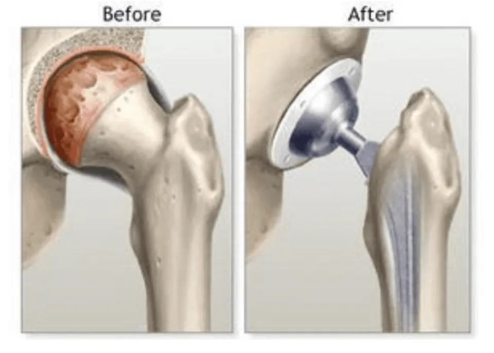 How Do You Fix a Loose Hip Replacement? (Solved)