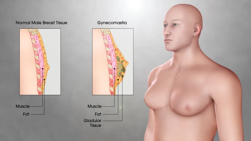 How to Get Rid of Gynecomastia Without Surgery? (3 Ways)