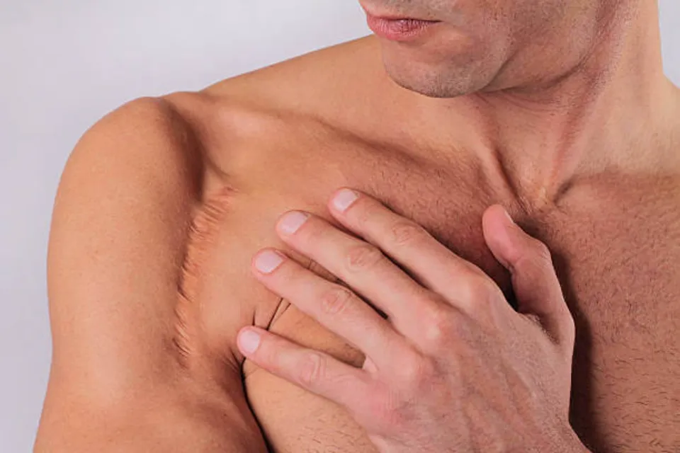 Shoulder Replacement: All Things You Need to Know