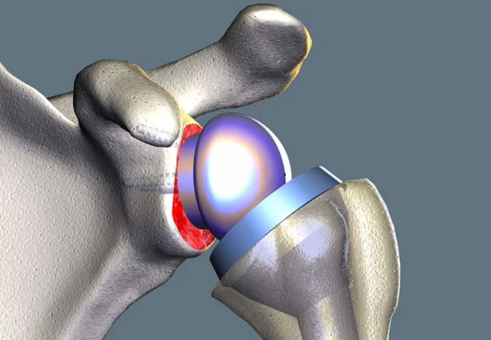 Shoulder Replacement Preparation: Tests Are Done Before Surgery